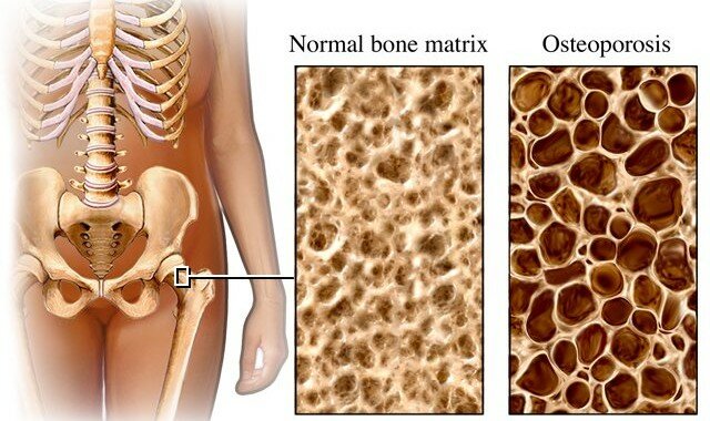 osteoporosis